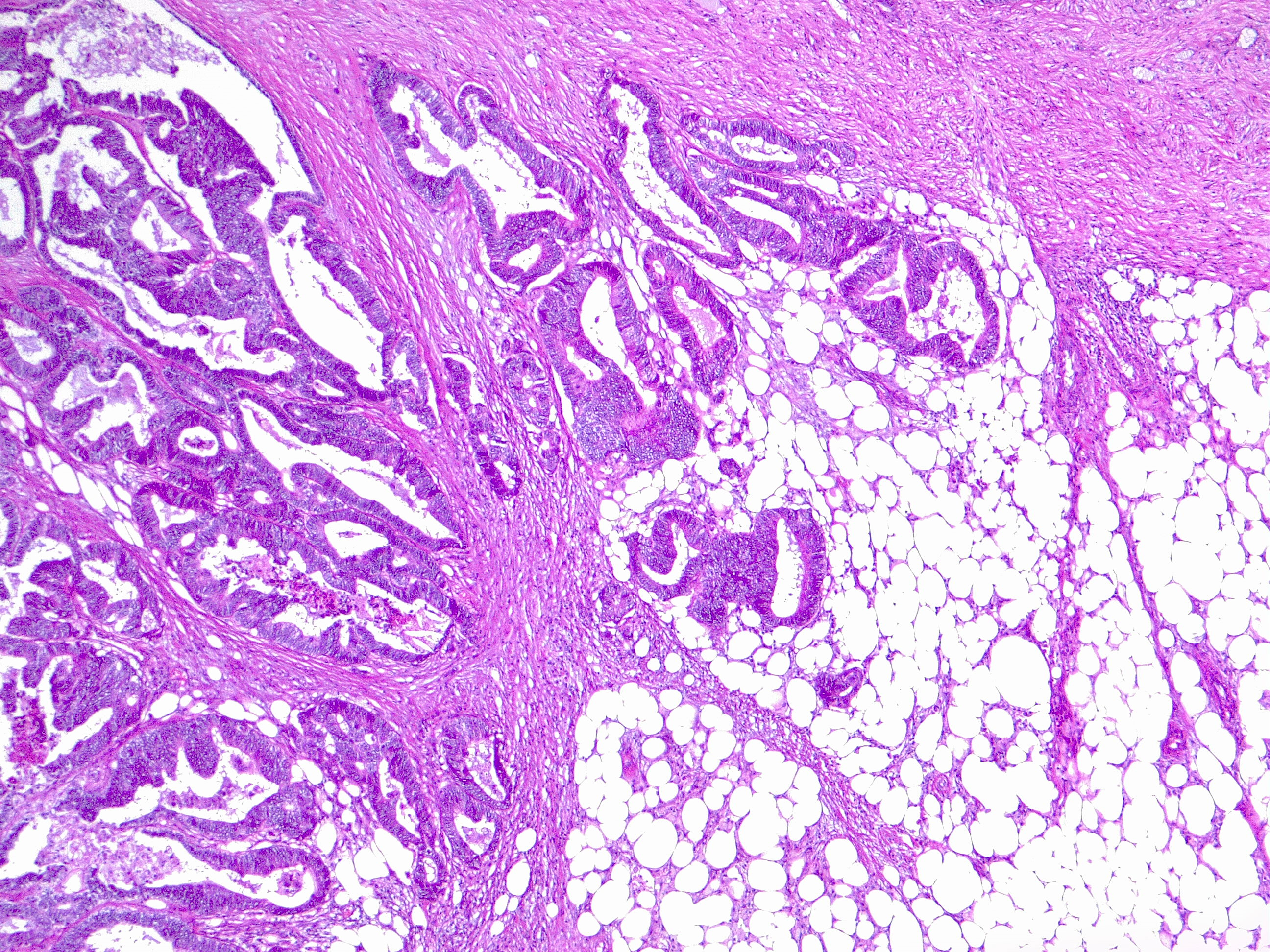 Colorectal cancer (CRC). In this image the neoplastic glands infiltrate the pericolic adipose tissue; this finding classifies as colorectal adenocarcinoma TNM stage pT3 (pathological staging). 