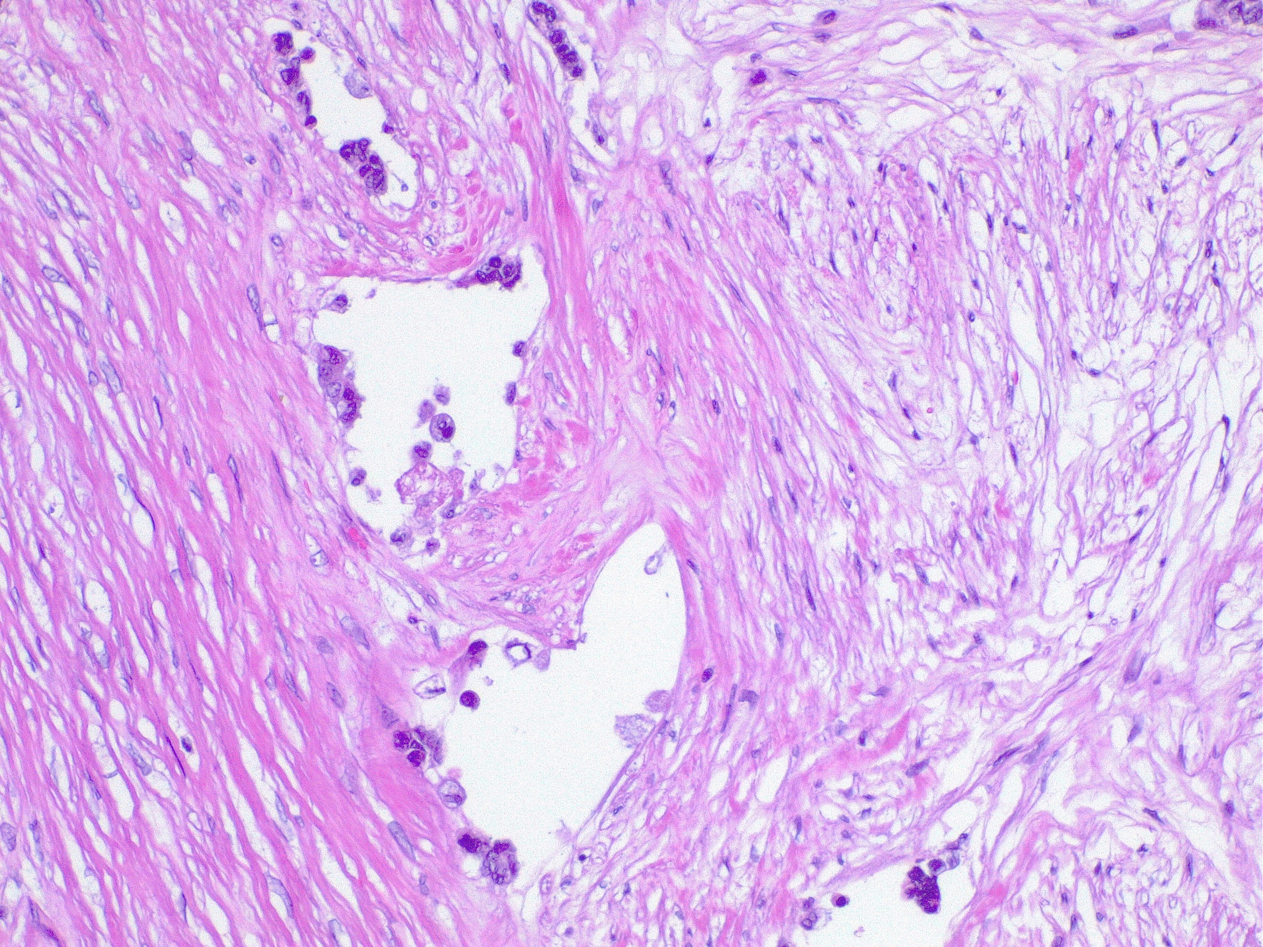 Colorectal cancer (CRC). Lymphatic space invasion by neoplastic cells. This is considered a negative prognostic factor, regardless of tumor grade or stage.