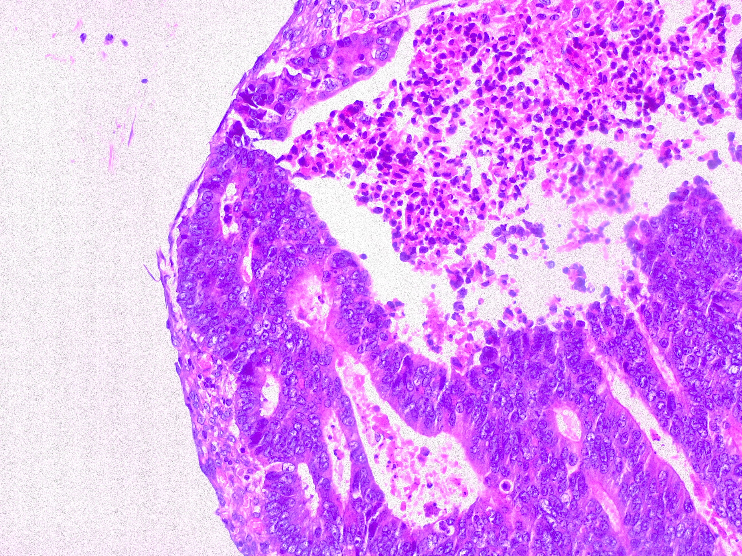 Colorectal cancer (CRC). In this image the neoplastic glands infiltrate the peritoneal mesothelium; this finding classifies as adenocarcinoma TNM stage pT4. 
