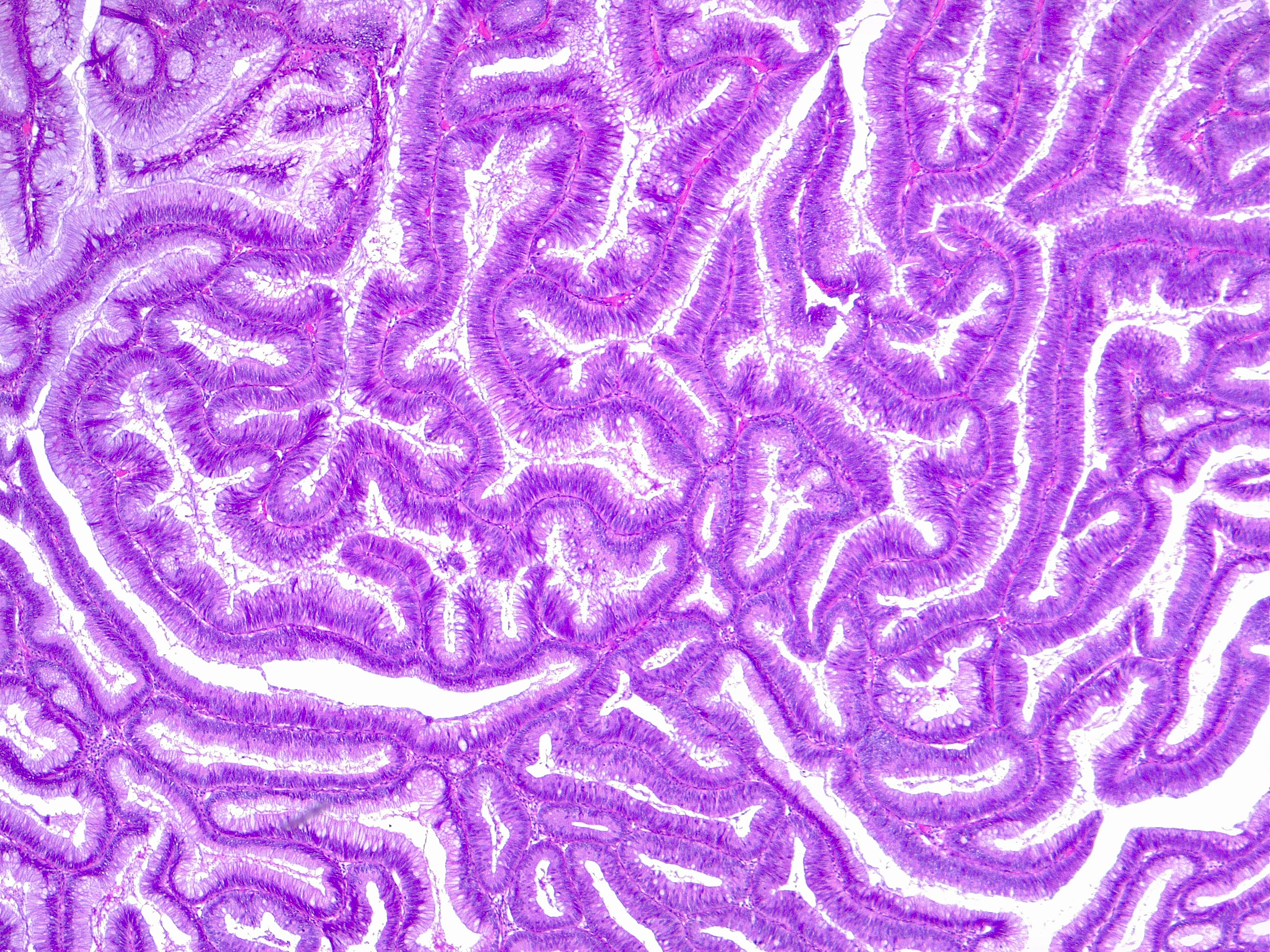 Villous adenoma. Typical complex architecture of mucinous glands, as depicted in this villous colon adenoma.