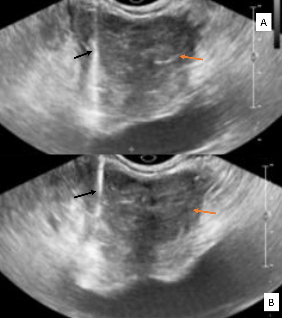 Trans rectal ultrasound guided biopsy of the prostate . Orange arrows- prostate ; Black arrows- biopsy needle