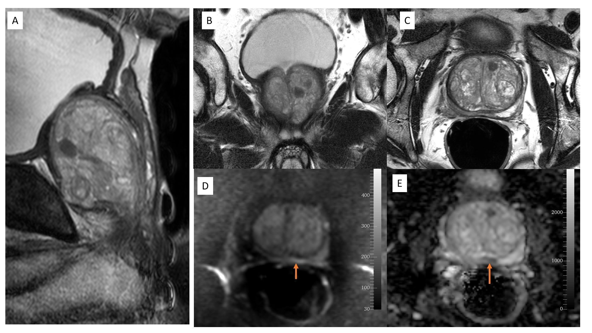 MRI Prostate: PIRADS- 2; A: Sagittal T2, B: Coronal T2, C: Axial T2, D: DW, E: ADC;
An ill - defined lesion in the peripheral zone; shows faintly hyperintensity on DW and suppressed faintly on ADC (restricted diffusion)