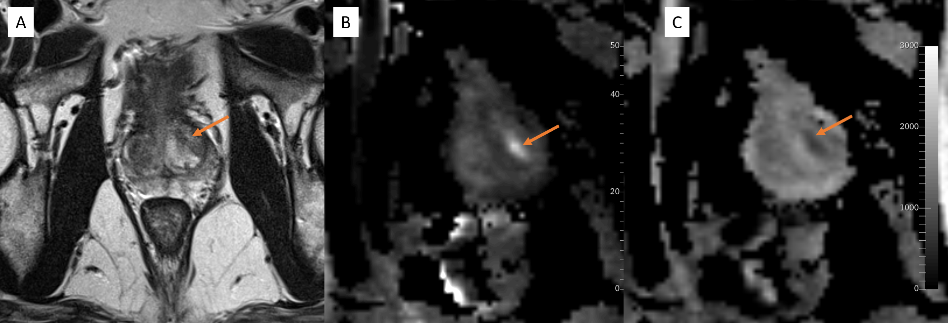 MRI Prostate: PIRADS-3; A: Axial T2, B: DW, C: ADC; A focal area of T2 Hypo intensity, shows faint diffusion restriction (orange arrow)