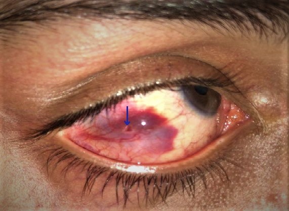 Subconjunctival hemorrhage with evidence of entry wound (blue arrow) in a 29 year old male following hammer and chisel injury