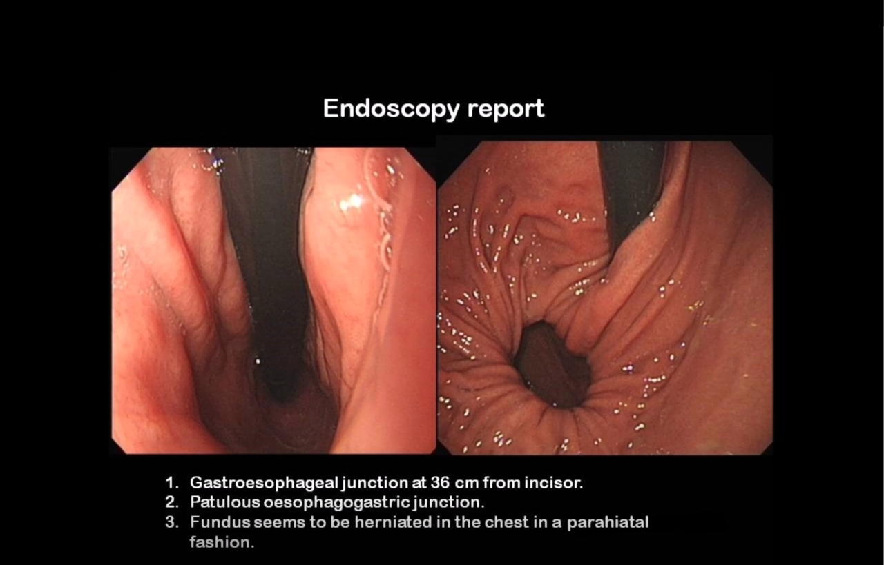 Endoscopic view of Parahiatal hernia