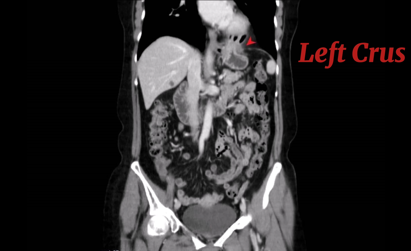 CT scan coronal view showing Left crus of diaphragm.