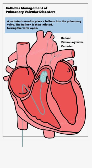 Catheter Management of Pulmonary Valvular Disorders, balloon, pulmonary valve