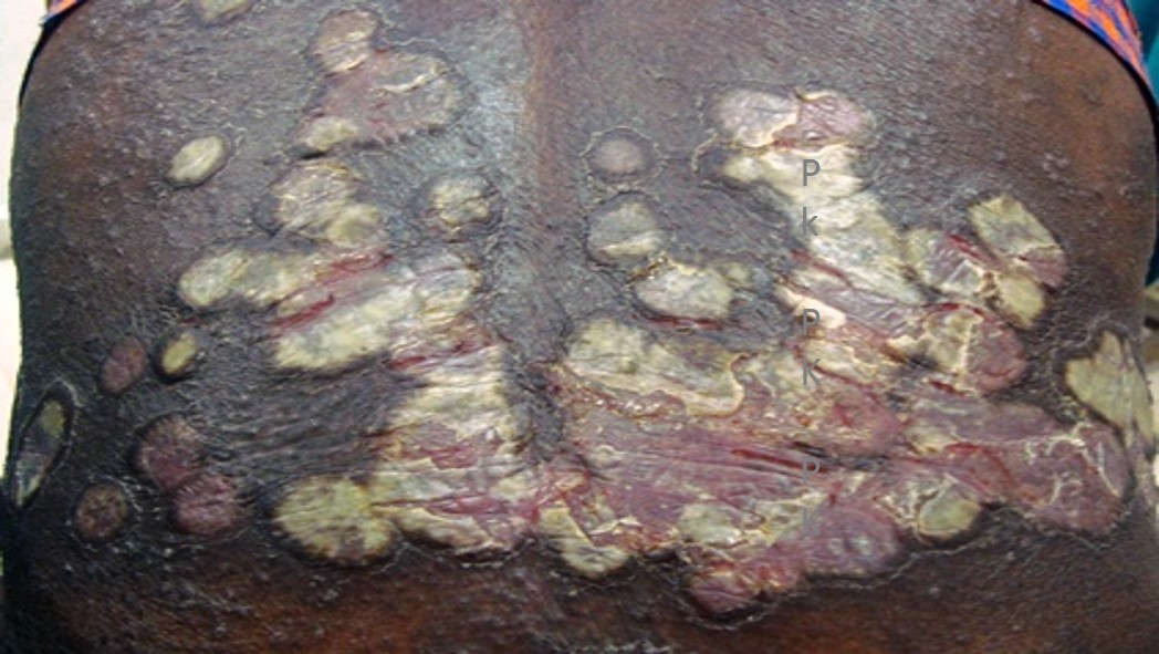 Erythematous scaly plaques of psoriasis over lower back note the silvery white scales and fissures.