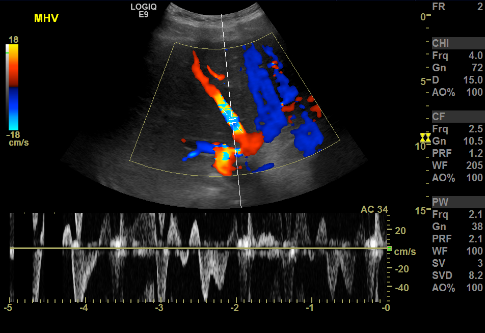 Hepatic venous doppler ultrasound showing aliasing artifact