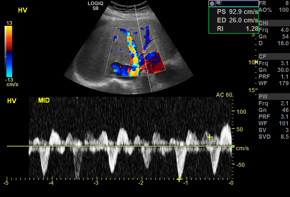 Color and doppler ultrasound of the hepatic veins with hepatic venous waveforms