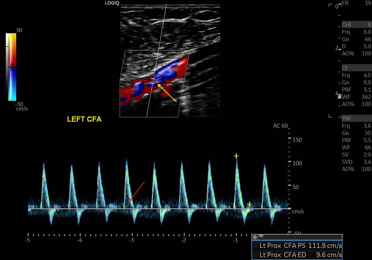 Doppler ultrasound showing typical triphasic waveform