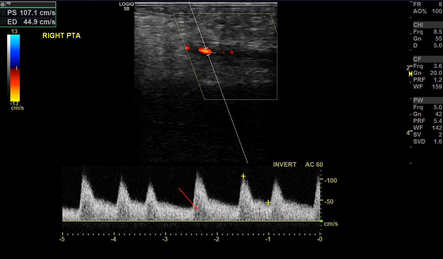 Doppler ultrasound of the right posterior tibial artery showing classic monophasic waveform