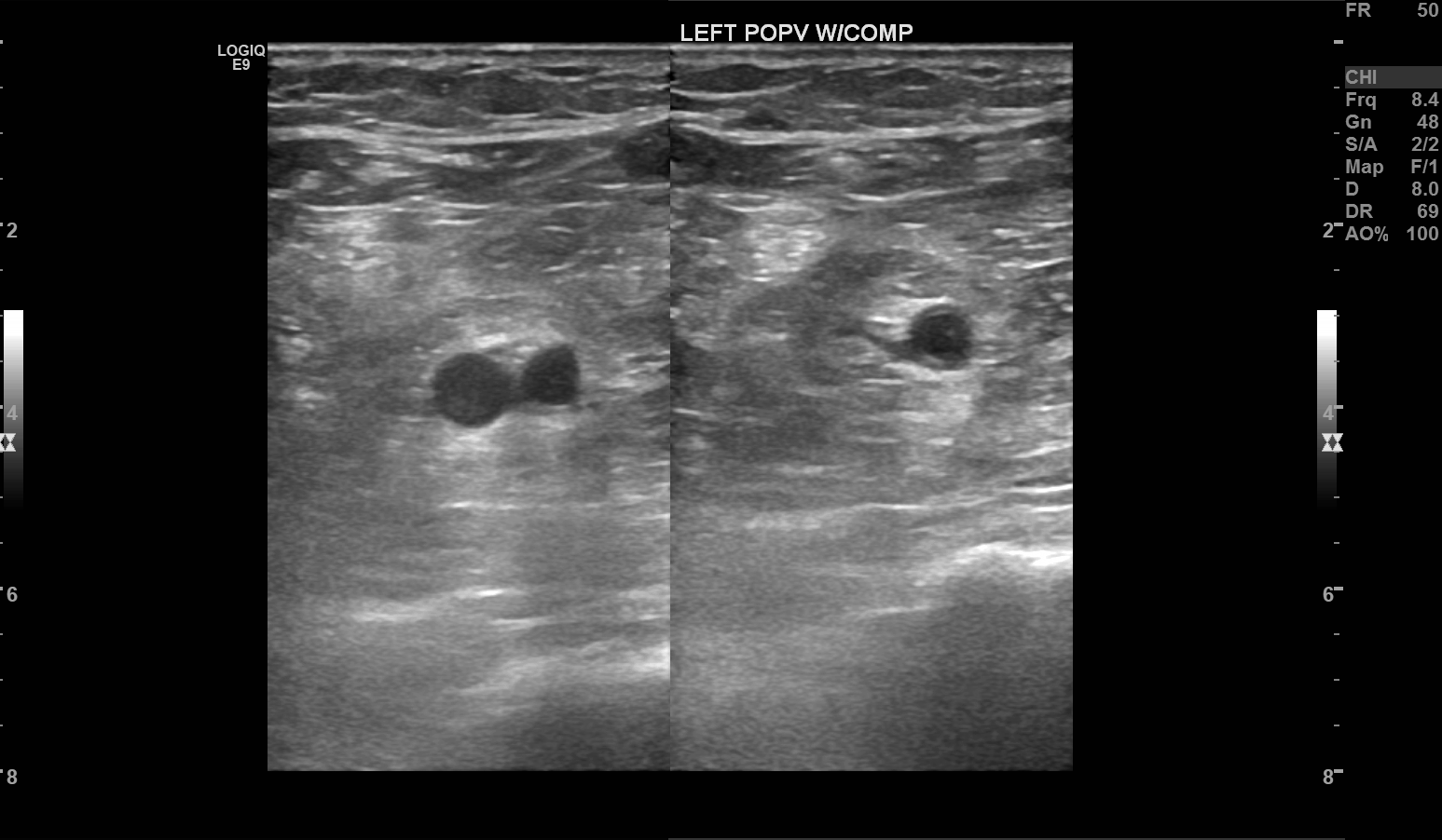 B-Mode doppler showing the left popliteal vein under compression. This compressibility is a normal finding.