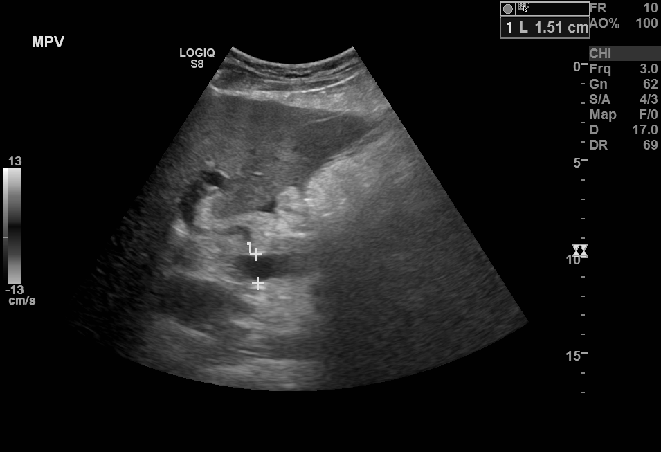 B-Mode ultrasound showing main portal vein diameter of 15.1 millimeters. This is an indirect finding of portal hypertension. 