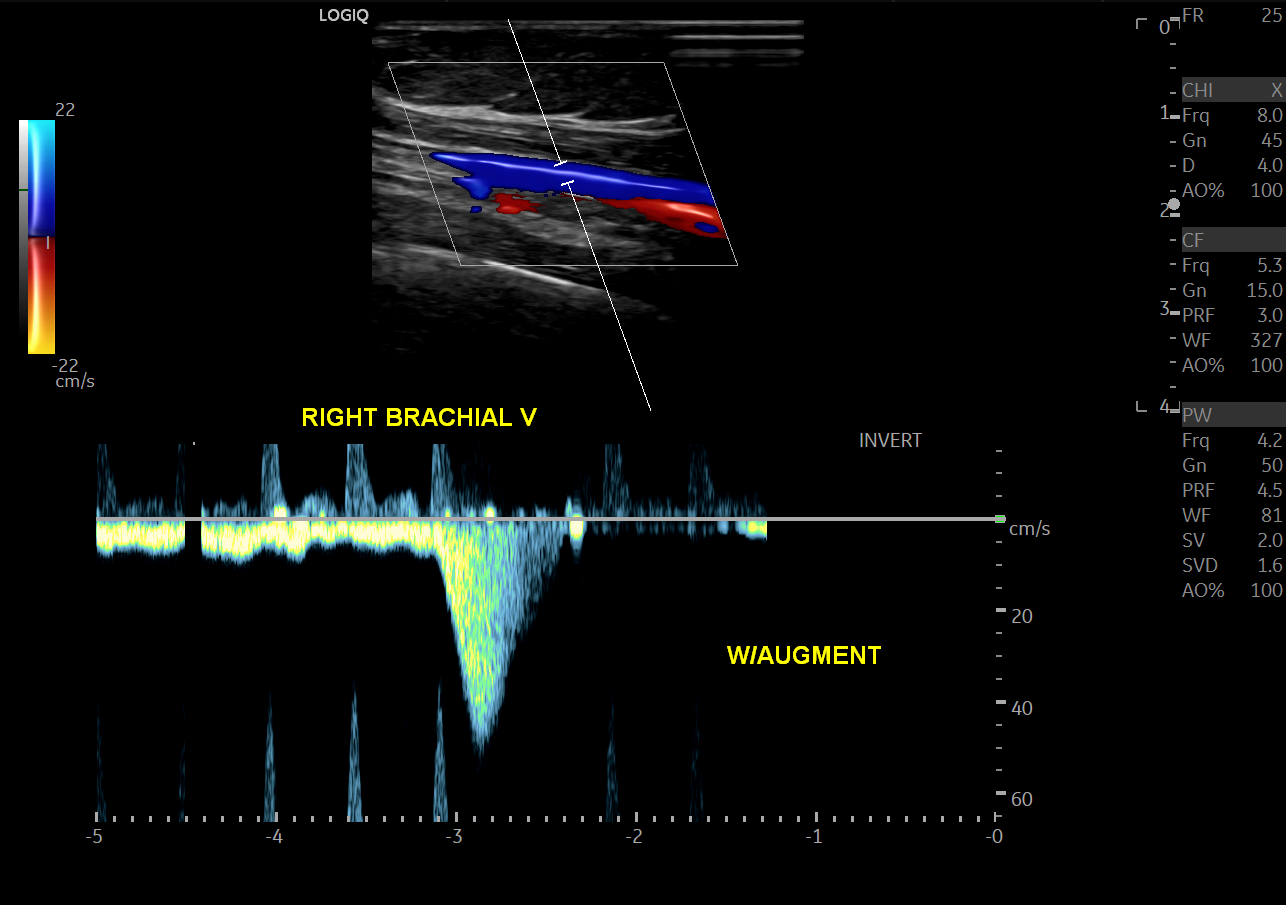 Doppler ultrasound of the right brachial vein that shows aliasing artifact