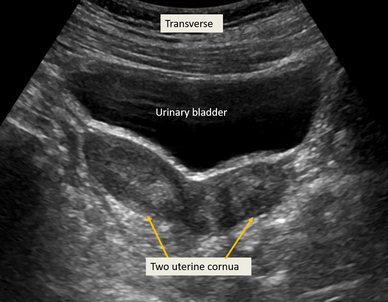 Transabdominal ultrasound of uterine didelphys: 2 uterine cornua are visible in transverse sections.