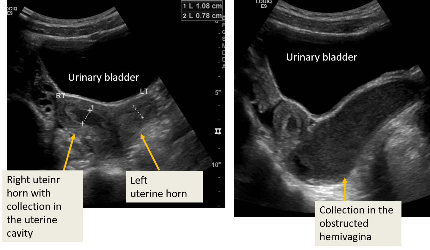 OHVIRA (obstructed hemivagina , ipsilateral renal anomaly) : Transabdominal ultrasound-transverse sections of pelvis- showing two separate uterine horns; obstructed hemivagina with echogenic collection (blood products) in the vaginal cavity and  right uterine horn. No collection in the left uterine horn.