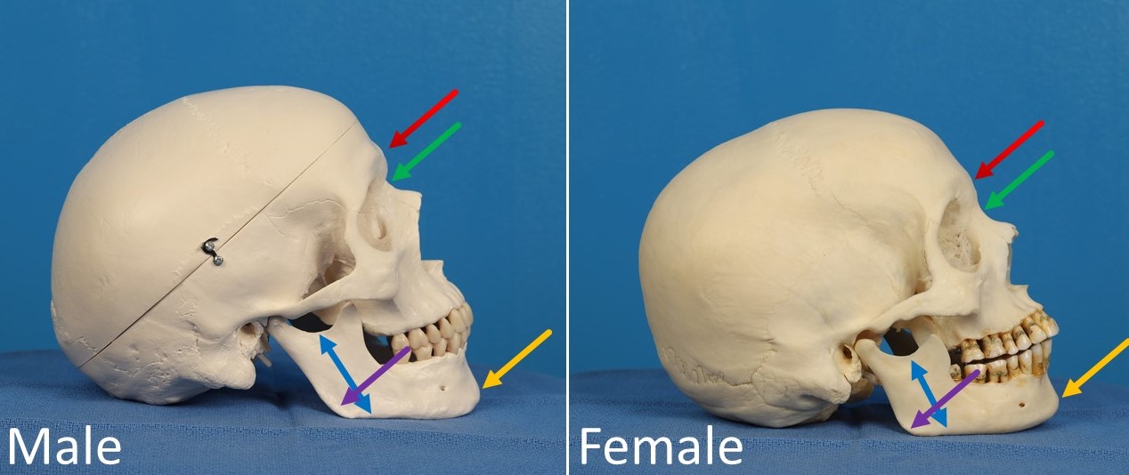 Differences between male and female skulls. The red arrow indicates frontal bossing, which is consistently more apparent in male skulls; the nasal radix (green arrow) is consequently deeper in the male skull. The yellow arrow demonstrates greater prominence of the chin in the male skull, and the blue arrows show a greater mandibular height in the male as well. In this example, the male skull has a more obtuse mandibular angle (purple arrow) than the female skull, which is atypical, illustrating the important point that not all of the listed sexually dimorphic traits are found in all patients.