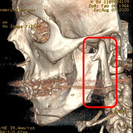 Iatrogenic vertical fracture of the mandibular ramus, extending through the sigmoid notch, that occurred during reduction of the mandibular angles during facial feminization. Note the plates in place fixating osteotomies for the frontal cranioplasty and genioplasty.