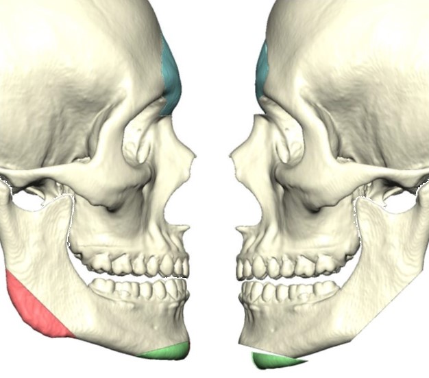 Surgical simulation based on 3-dimensional rendering of preoperative CT scan demonstrating planned reductions in frontal bossing, mandibular angle, and chin projection. 