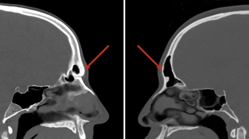 CT scans demonstrating different thicknesses of anterior tables of frontal sinuses; thickness of the bone may have a major impact on the surgical plan.