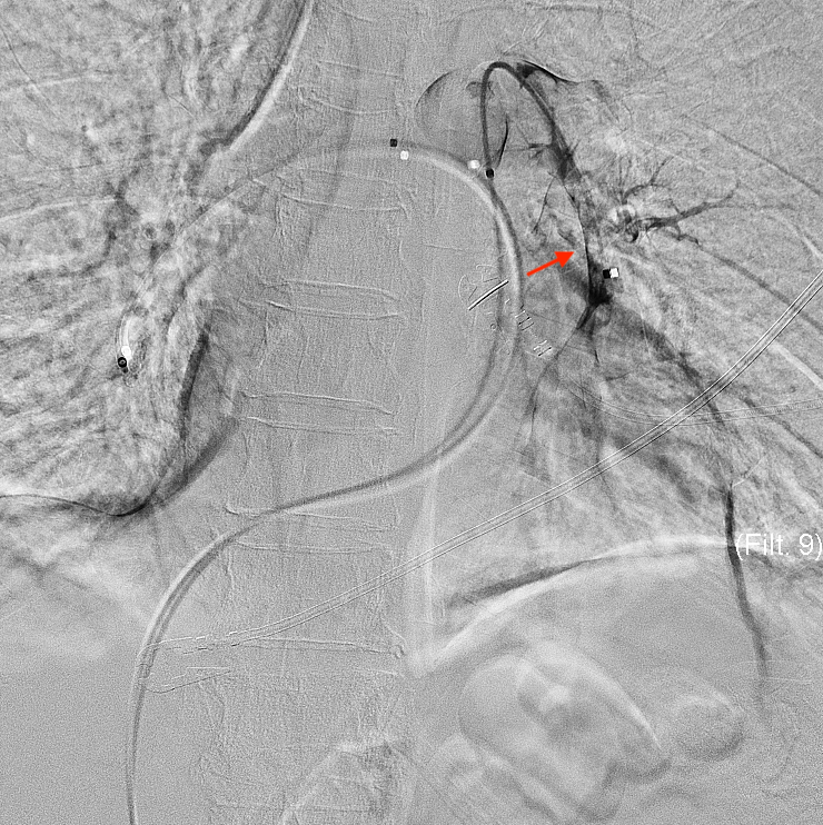 Pulmonary angiography depicting filling defects (red arrow) consistent with pulmonary embolism