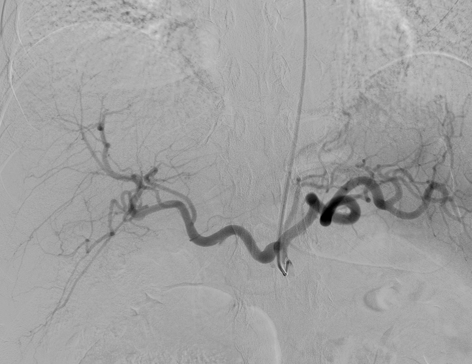 Fluoroscopy-guided angiography with selective catheterization of the celiac artery