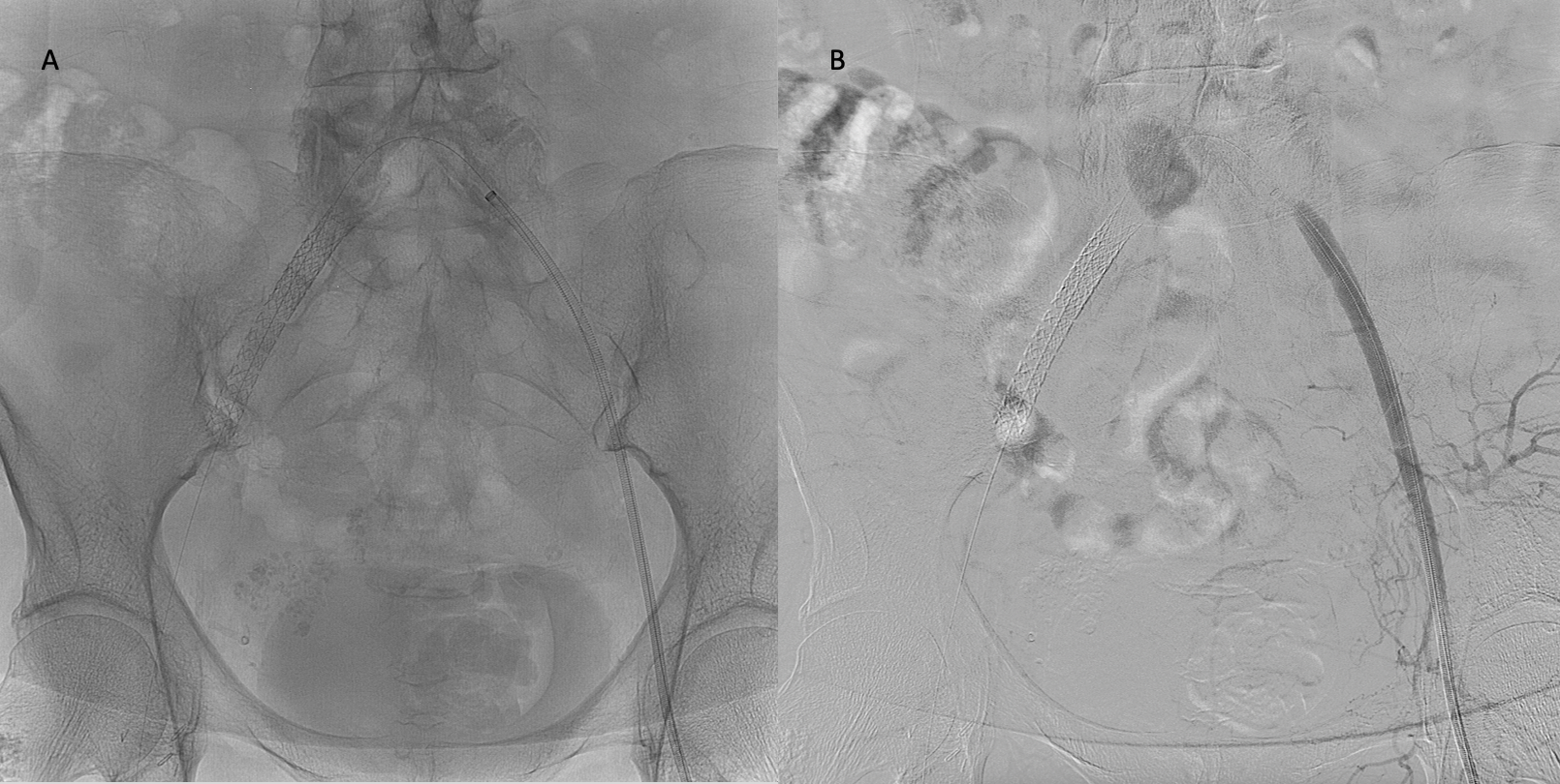 Image A shows normal fluoroscopy while image B shows digital subtraction angiography