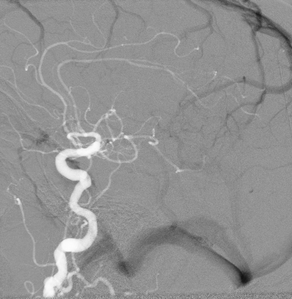 Cerebral Angiography shows an example of road-mapping