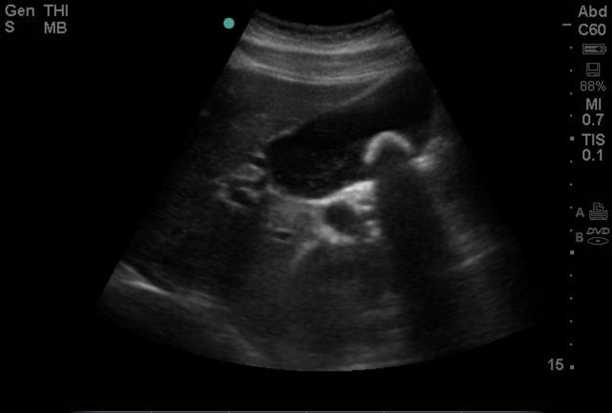 Gallstone on point-of-care ultrasound