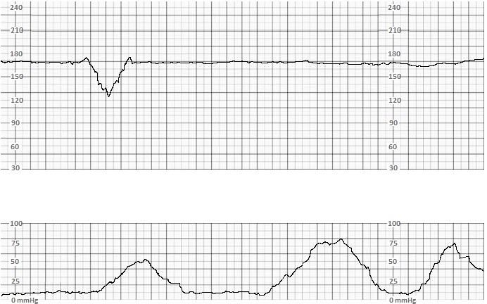 Category II tracing: Fetal tachycardia, reduced long-term variability, occasional variable decelerations