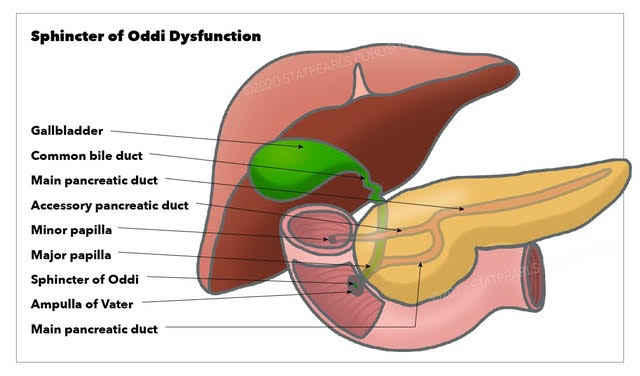 Sphincter of Oddi Dysfunction, gallbladder, common bile duct, main pancreatic duct, accessory pancreatic duct, mini papilla, 