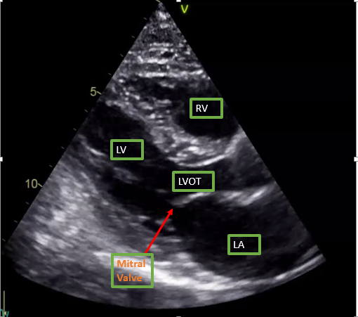 Parasternal long axis view on Transthoracic echocardiogram