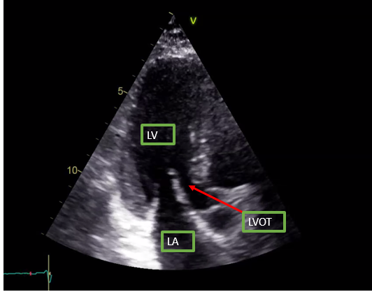 Apical parasternal long axis on Transthoracic echocardiography