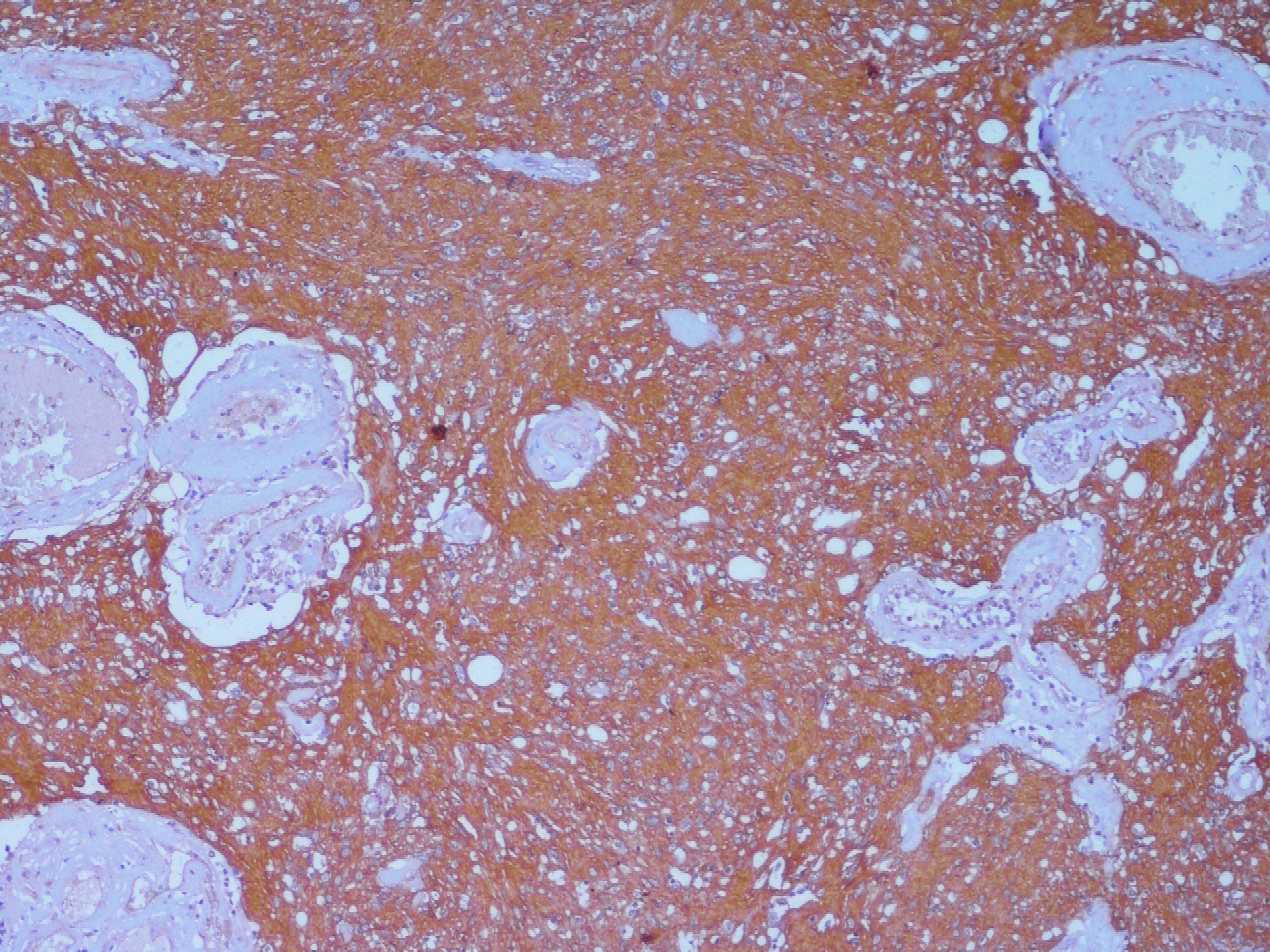 Immunohistochemistry stain, Glial Fibrillary Acid Protein, showing intense positivity for glial tissue within the inner wall 