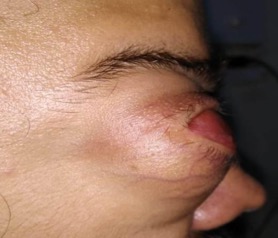 Clinical Photograph, Lateral view, showing a massive right-sided orbital mass with overlying telangiectatic vessels