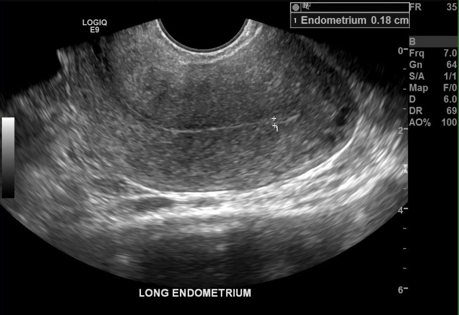 The semicircular region in the superior portion of the image indicates that this is a transvaginal ultrasound. This is a sagittal image (long axis) of the uterus with the cephalad portion on the left as indicated by the LOGIC label. This is a retroflexed uterus that may be a normal variant or occurs as a result of endometriosis in the posterior cul-de-sac or from surrounding adhesions. The endometrium as indicated by the calipers is of normal thickness and echogenic pattern.