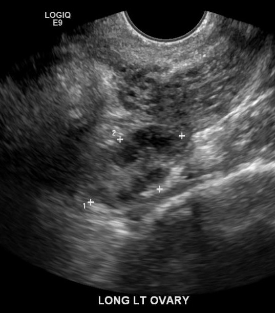 This is a sagittal image of the left ovary. Physiologic follicles are noted.