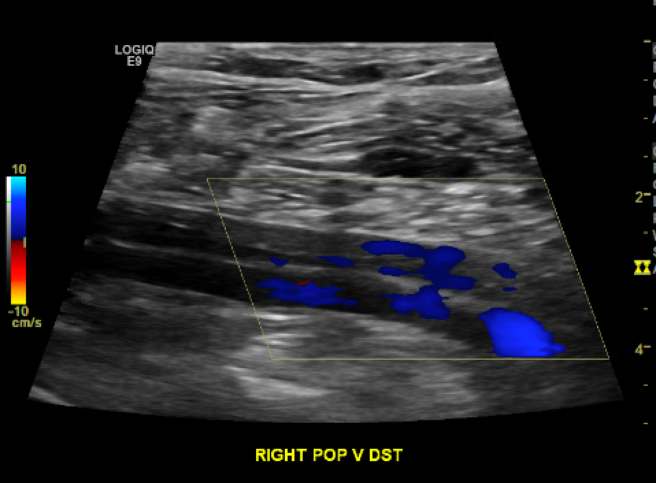 Chronic Non-occlusive DVT within a duplicated popliteal vein.
There is hyperechoic, eccentric thrombus that appears partially re-canalized with some color flow seen.