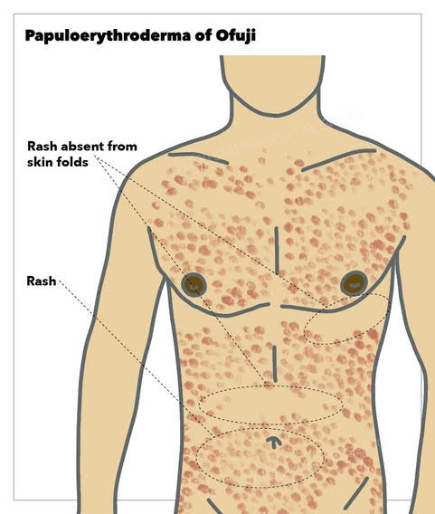 Papuloerythroderma of Ofuji, rash, skin folds