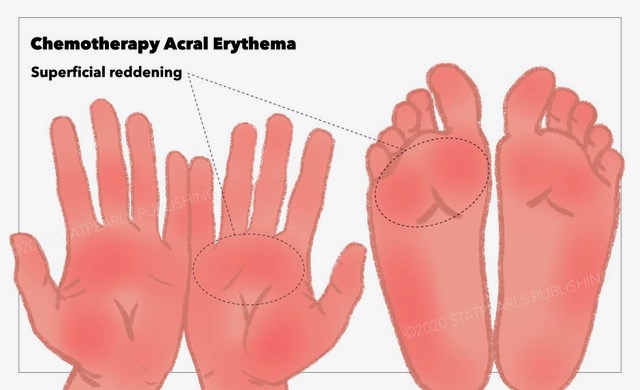 Chemotherapy Acral Erythema, reddening, hands, feet