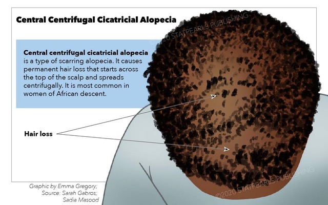 Central Centrifugal Cicatricial Alopecia, hair loss, scalp, women