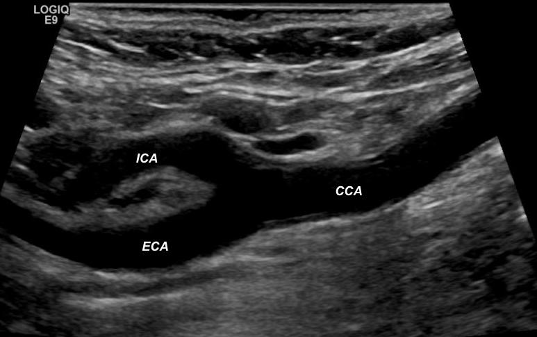 Grayscale image of carotid bifurcation showing common carotid artery (CCA), internal carotid artery (ICA) and external carotid artery (ECA). 