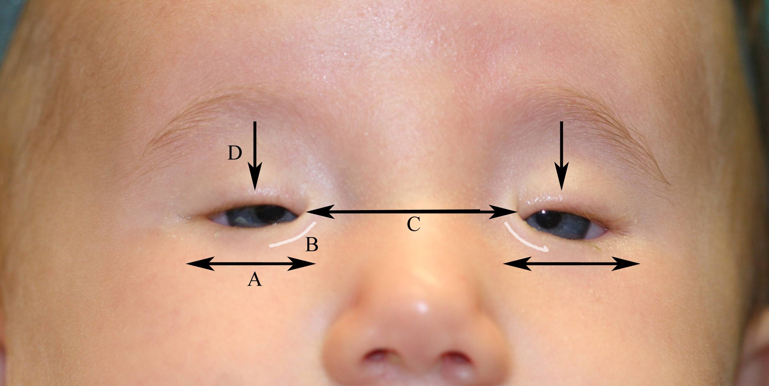 Blepharophimosis Syndrome: A. Blepharophimosis B: Epicanthus Inversus C: Telecanthus D: Ptosis