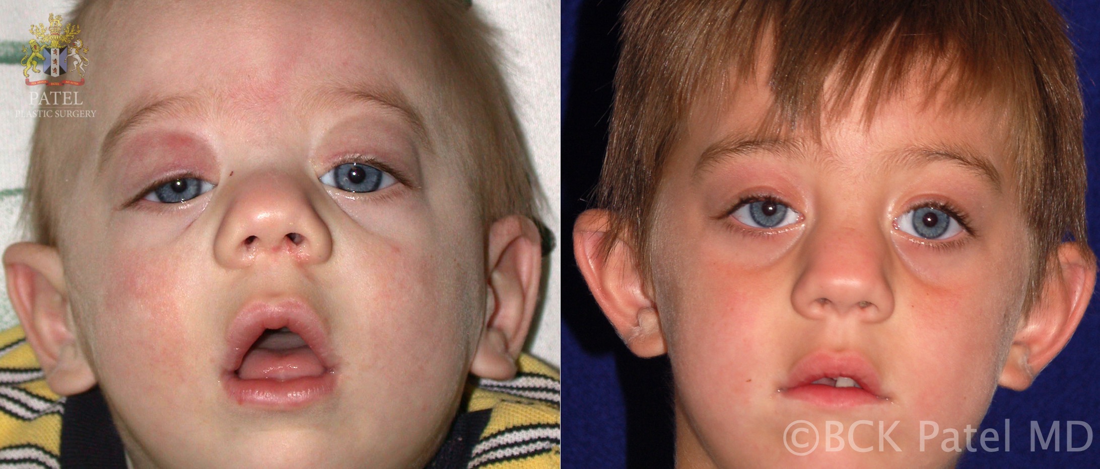 Congenital ptosis: severe bilateral congenital ptosis with the chin-up position and poor levator function with over action of the frontalis muscles. Bilateral frontalis slings corrects the eyelid position and the chin-up position