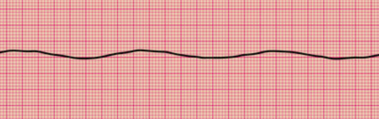 <p>Asystole on Electrocardiography. This rhythm strip shows the total absence of an organized rhythm.</p>