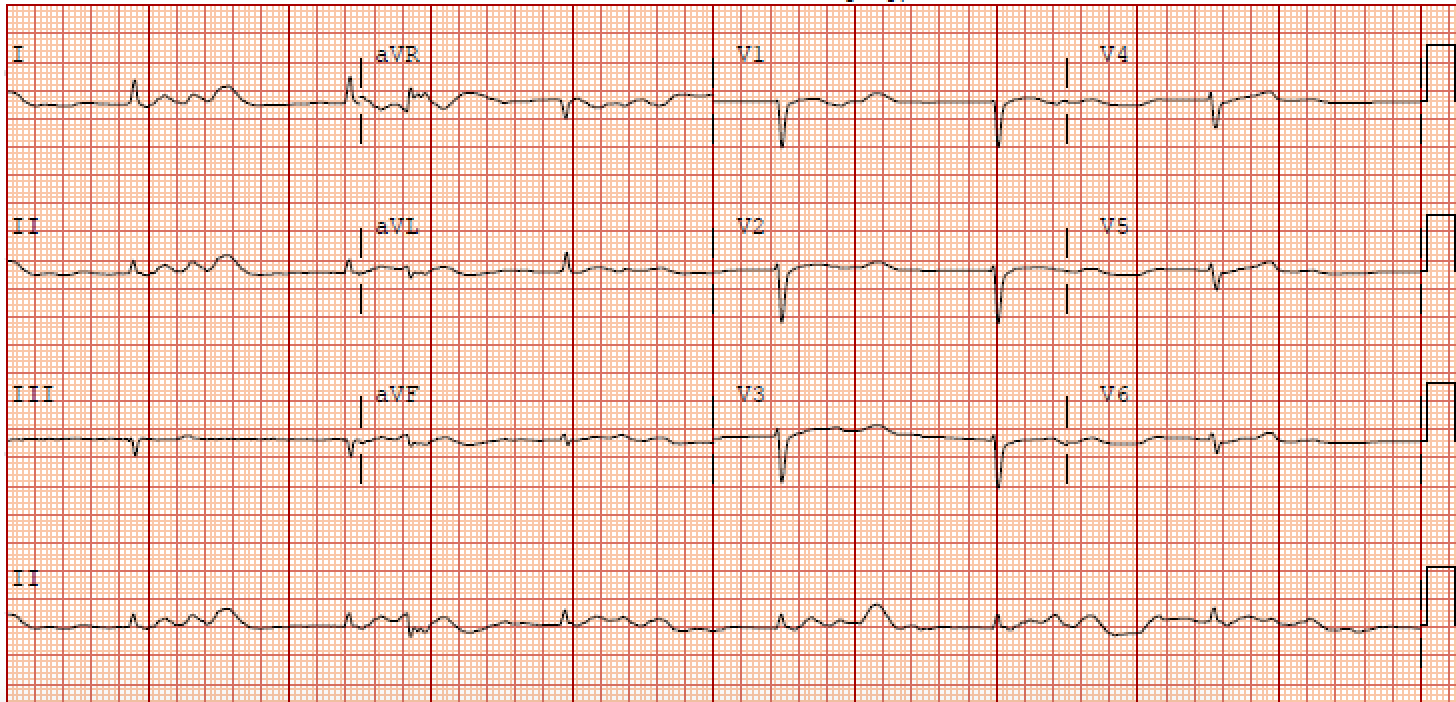 Electrocardiographic findings in BRASH syndrome