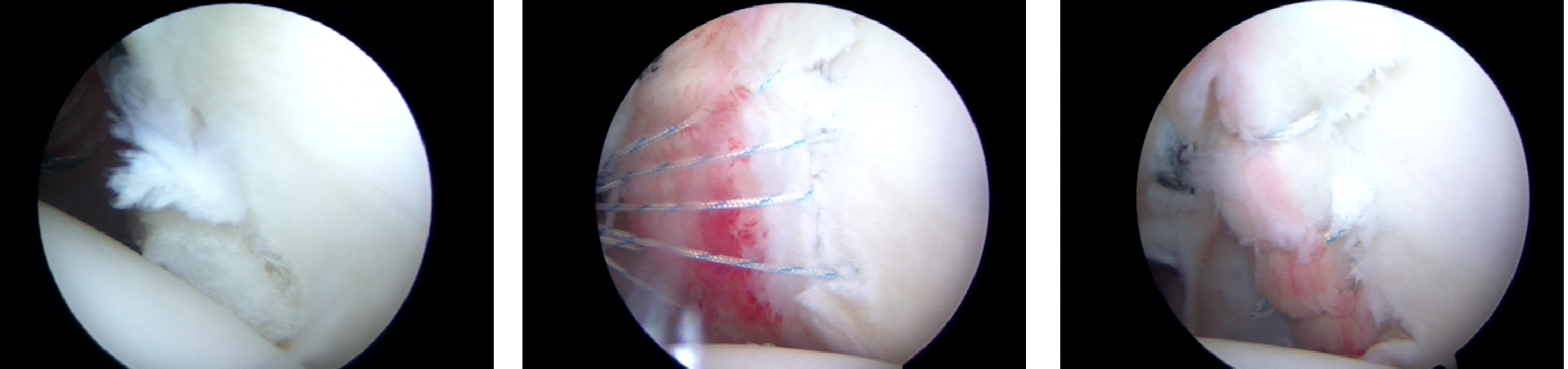 Arthroscopic View of Right Shoulder posterior Bankart tear associated with a posterior shoulder dislocation.  Left image: Posterior Labrum tear, Middle image: All-Suture anchors placed into the glenoid, Right Picture: Repaired Posterior Labrum tear.