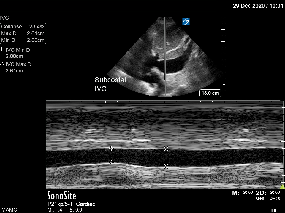 M-Mode showing motion through a single beam path.  In this case, the inferior vena cava shows subtle collapsibility that is more difficult to discern without M-Mode.