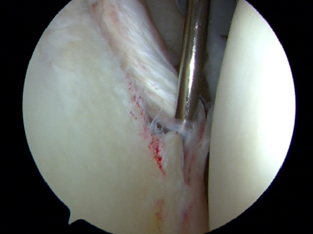 Right Shoulder arthroscopic view of an Anterior Bankart or labrum tear after anterior shoulder dislocation.